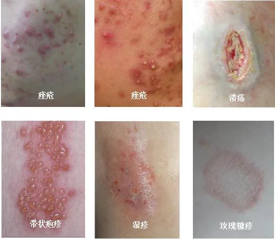 百色市中医医院皮肤科引进红蓝光治疗仪和二氧化碳激光治疗仪