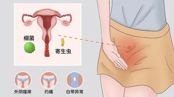 【健康科普】痒痒痒!但这痒不能乱抓——中医专家教您如何应对“外阴瘙痒”