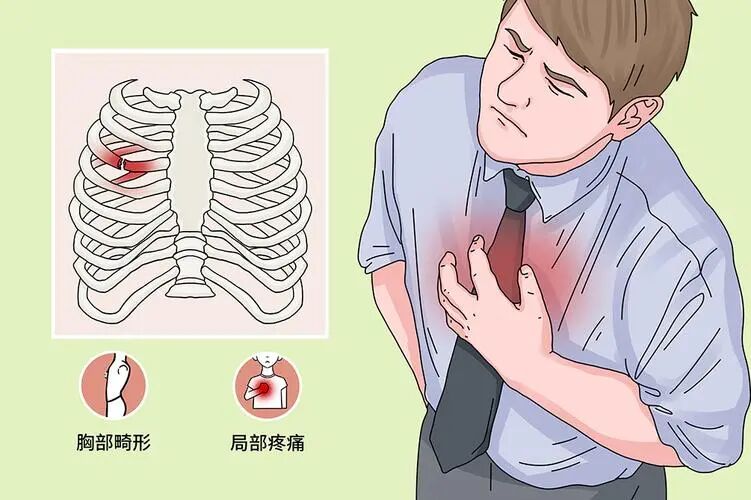 【健康科普】肋骨骨折:一种让你“不敢深呼吸”的伤