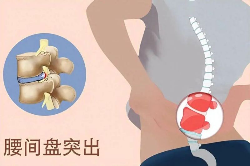 【健康科普】腰椎间盘突出症日常保养小妙招