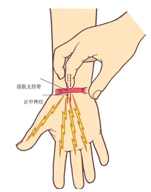 【健康科普】腕管综合征：鼠标手背后的秘密