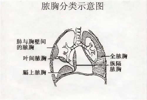 【健康科普】胸痛咳嗽，积水其中——中医带您了解脓胸