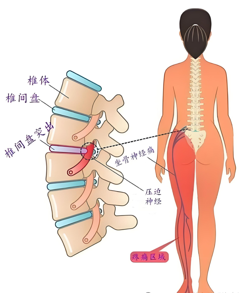 【健康科普】腰腿痛难忍？了解下微创“溶解术”